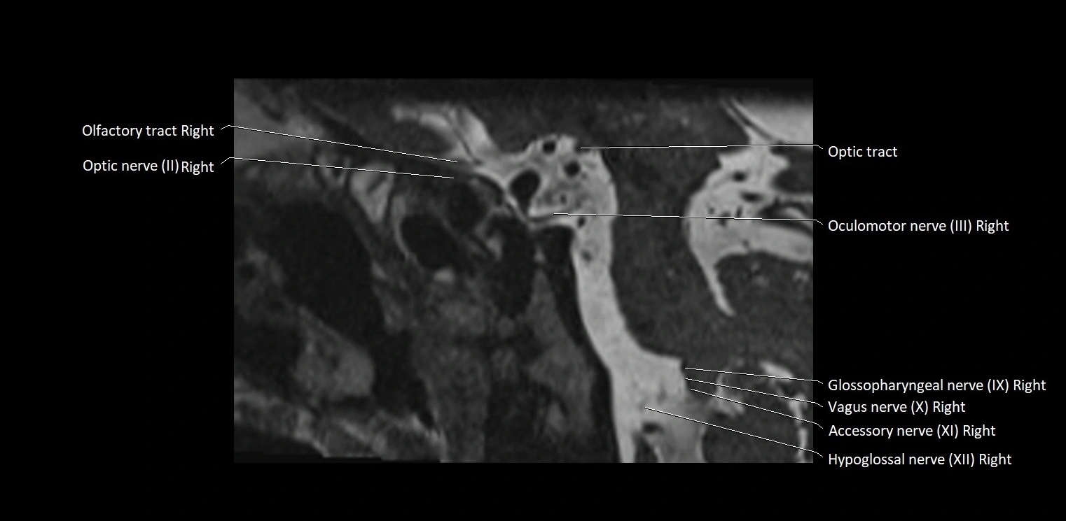 Cranial nerve sagittal anatomy MRI 3T image 39.webp